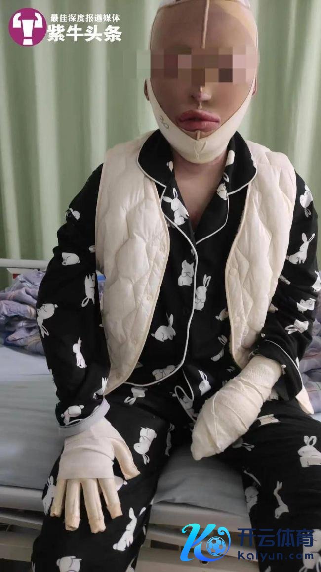 遭前男友泼汽油毁容女生发声 抗诉得胜将迎二审